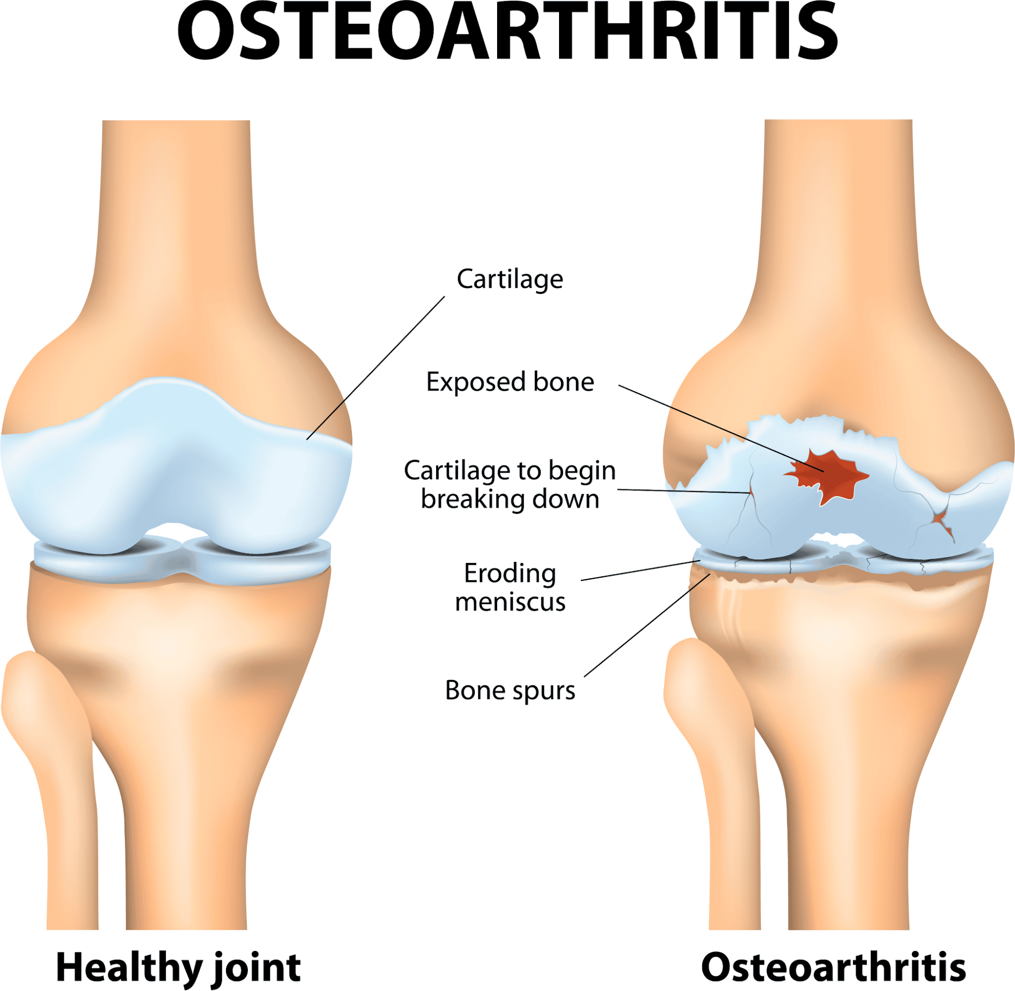 Medical illustration comparing a healthy knee joint with osteoarthritis, including damaged cartilage, exposed bone, an eroding meniscus and bone spurs