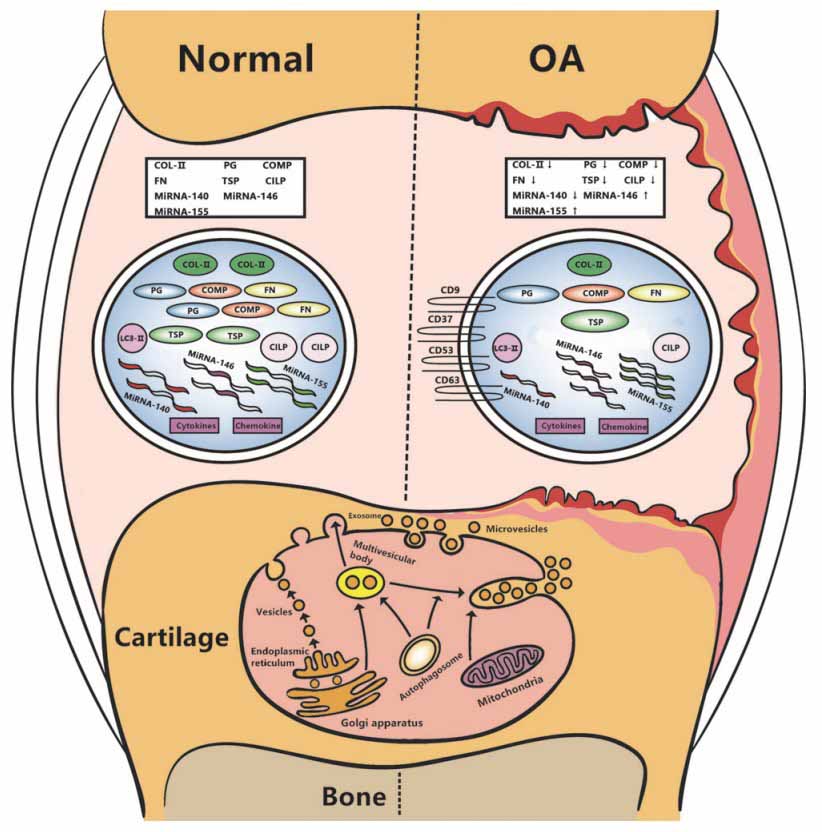 https://anova-irm.com/images/InfoProfessionals/OA-changes-in-Cartilage-and-Joint.jpg