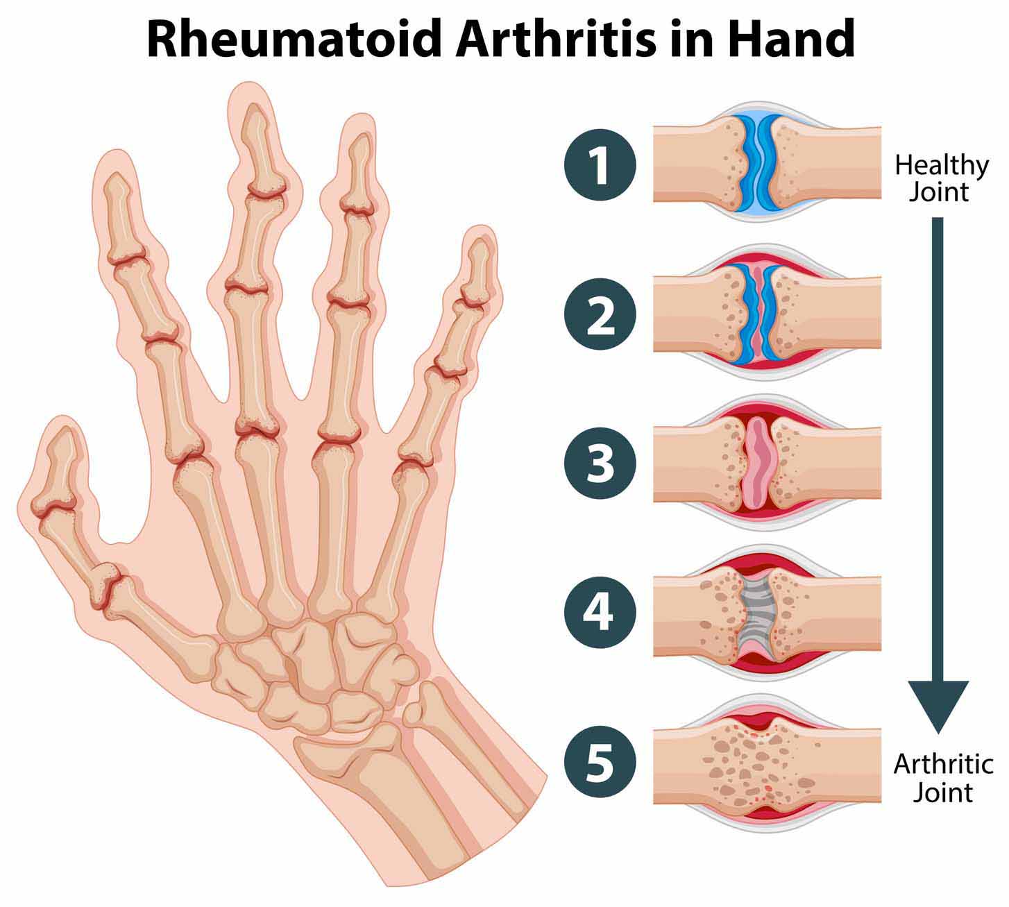 rheumatoid arthritis boka áttekintése meghajolja a térd és a boka ízületét