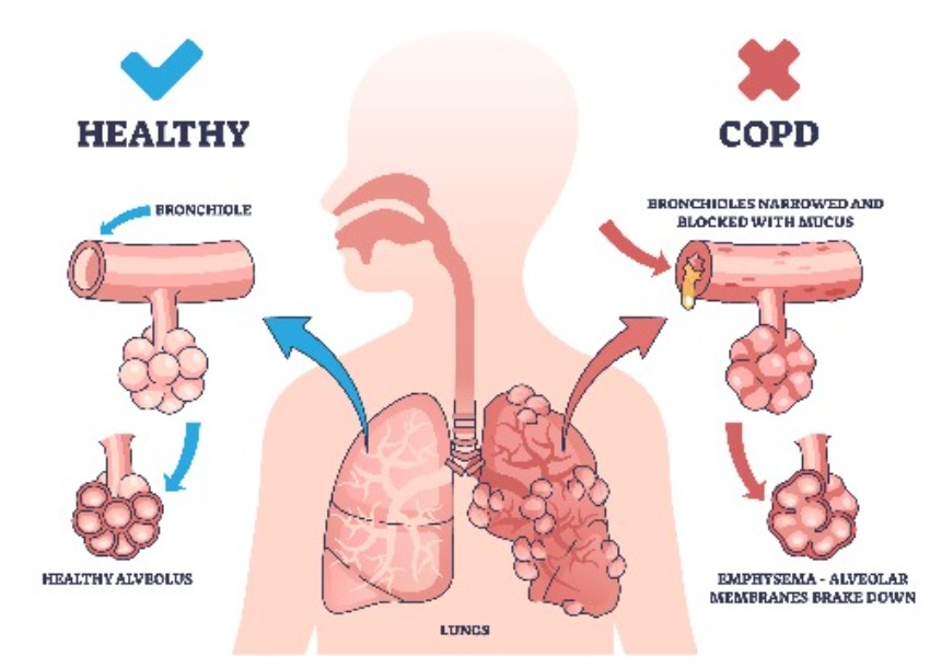 Comparison of a healthy lung and a lung affected by COPD, showing inflammation and alveolar damage. Diagram comparing Healthy Lung vs. COPD Affected Lung