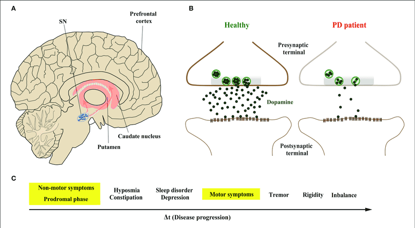 ANOVA-IRM-Germany-Parkinsons-disease-PD-dopaminergic-neurons-stem-cell-therapy