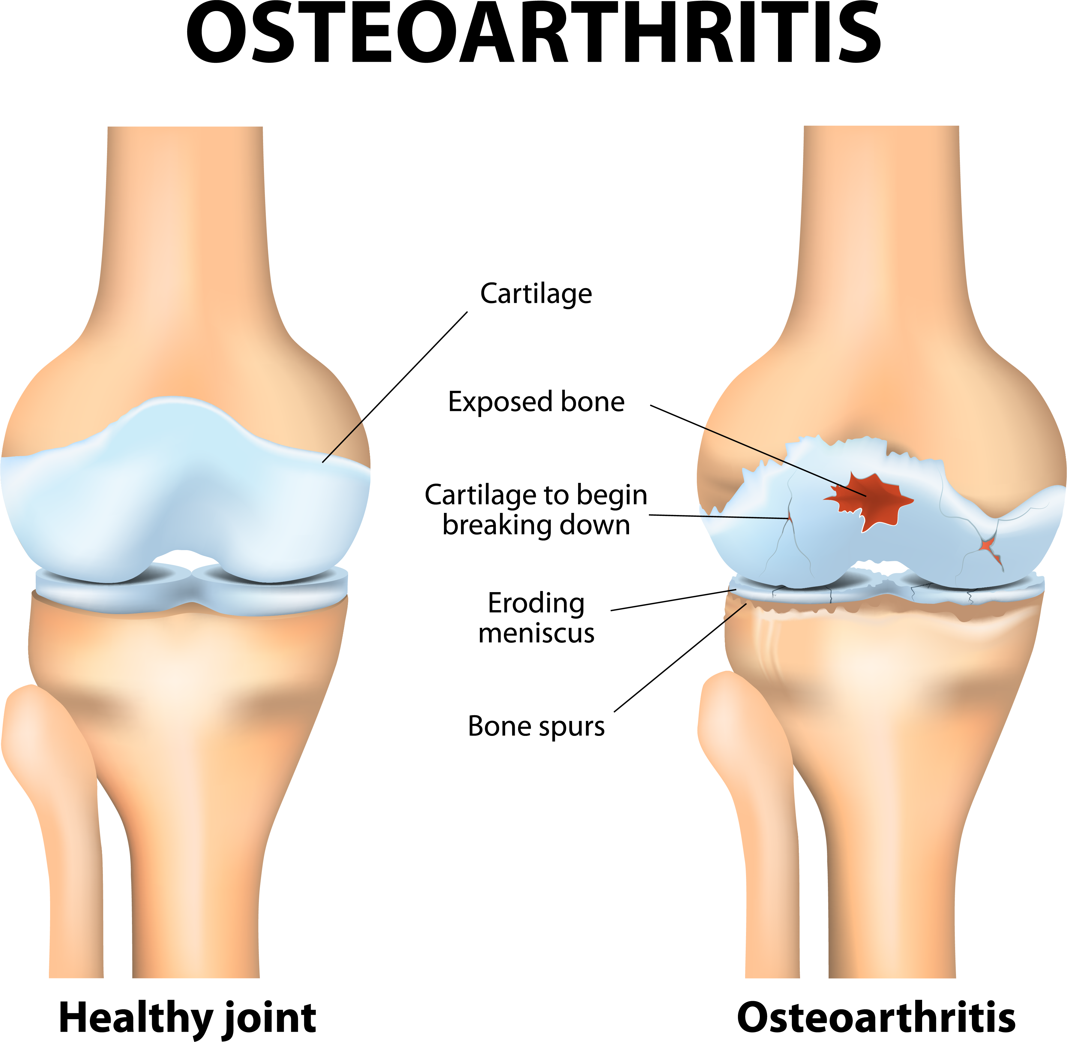 Joint and cartilage degeneration in OA | ANOVA
