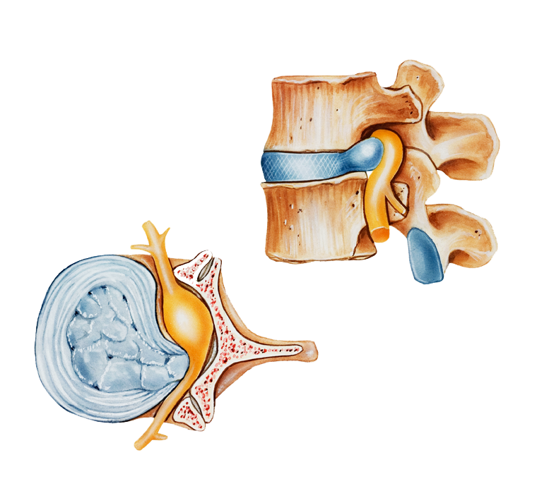 Back pain and degenerative disc disease nerve compression | ANOVA
