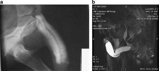 Pharmacocavernosography and MRI showing venous leakage in a patient with organic erectile dysfunction