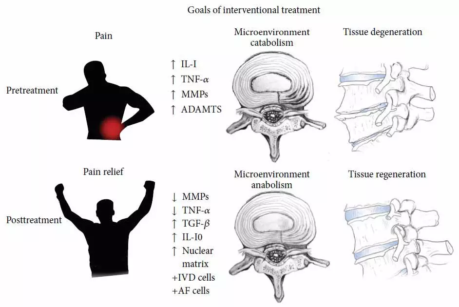 Stem Cell Treatment of Degenerated Discs and Back Pain