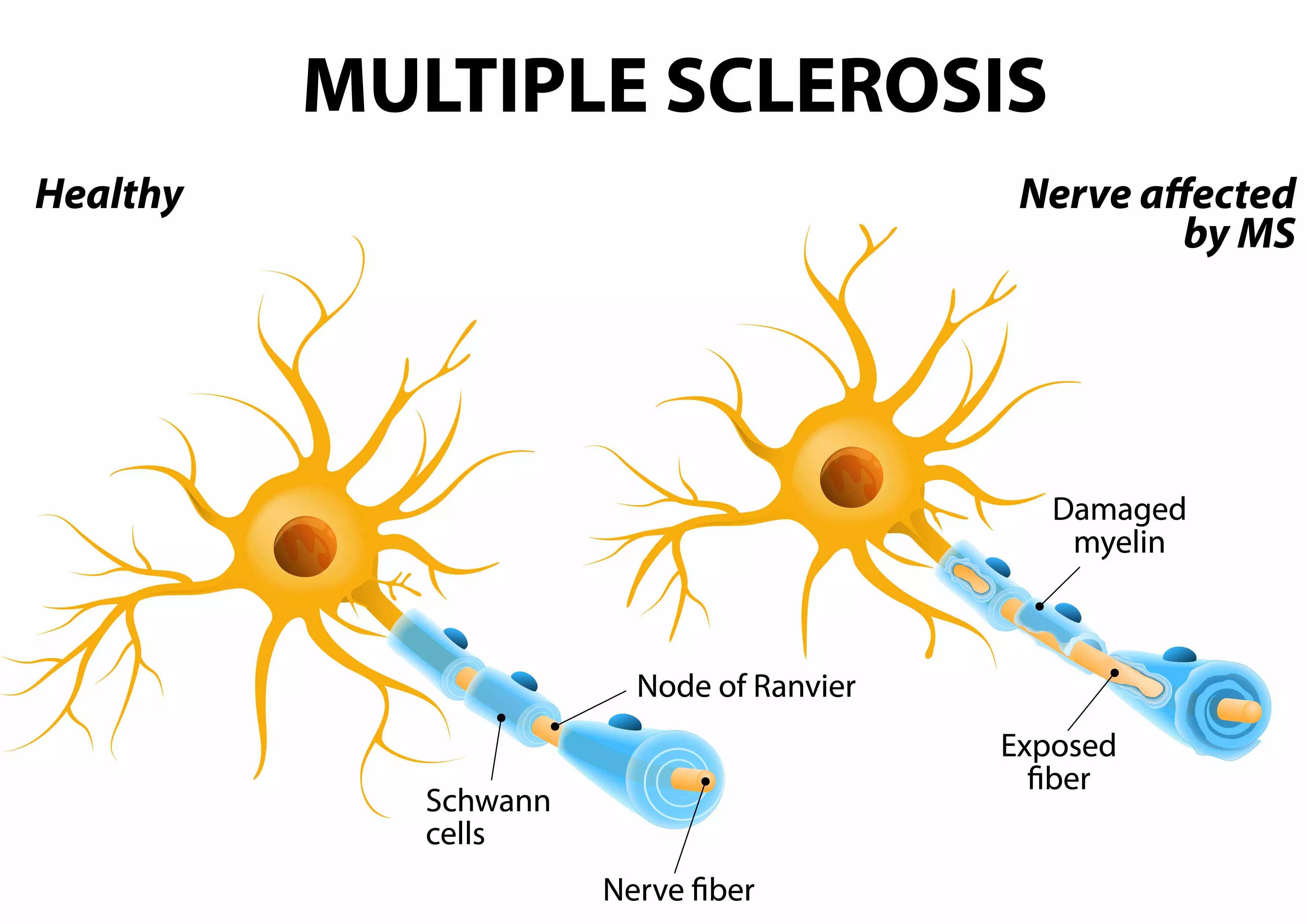 Gesundes Neuron vs. von Multipler Sklerose betroffenes Neuron. MS Neuron Unterschiede