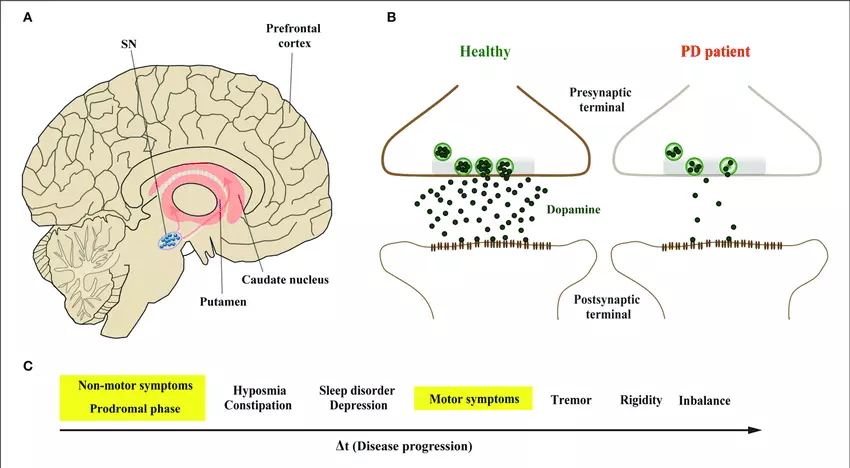 ANOVA-IRM-Deutschland-Parkinson-Krankheit-PD-dopaminerge-Neuronen-Stammzelltherapie ANOVA-IRM-Deutschland-Parkinson-Krankheit-PD-dopaminerge-Neuronen-Stammzelltherapie