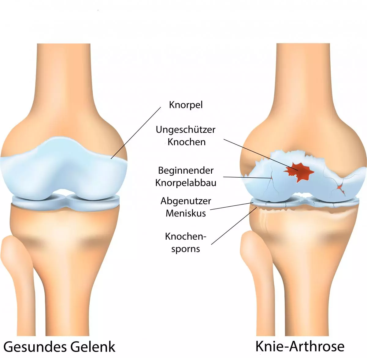Gelenkschäden bei Arthrose und Arthritis Gelenkschäden bei Arthrose und Arthritis | ANOVA IRM