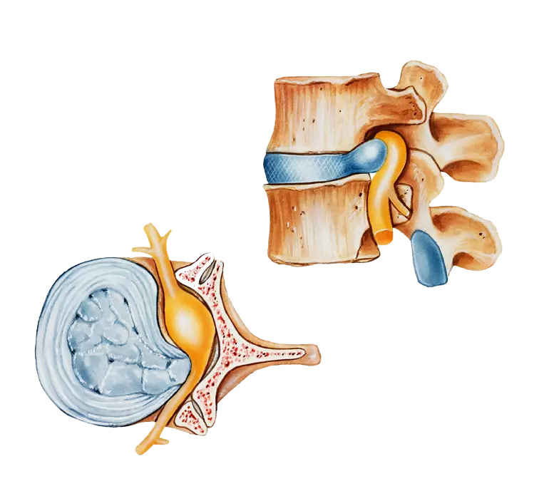 Back pain and degenerative disc disease nerve compression | ANOVA Germany Back pain and degenerative disc disease nerve compression | ANOVA
