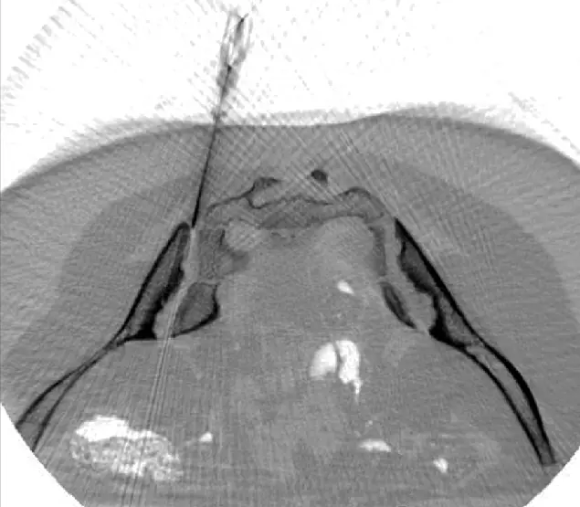 ANOVA IRM Deutschland CT-guided stem cell injection into joint tissue