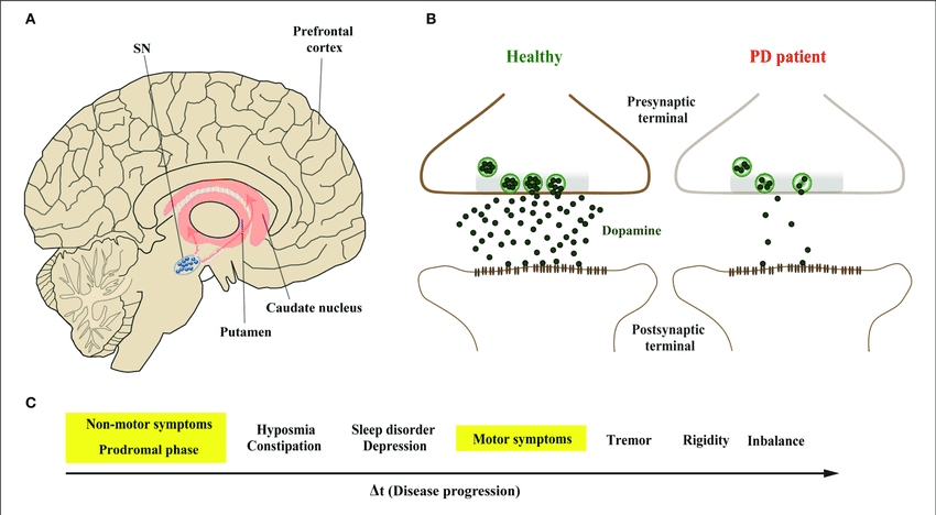 Substantia nigra degeneration showing dopamine neurons lost and reduced dopamine signalling in Parkinson’s disease