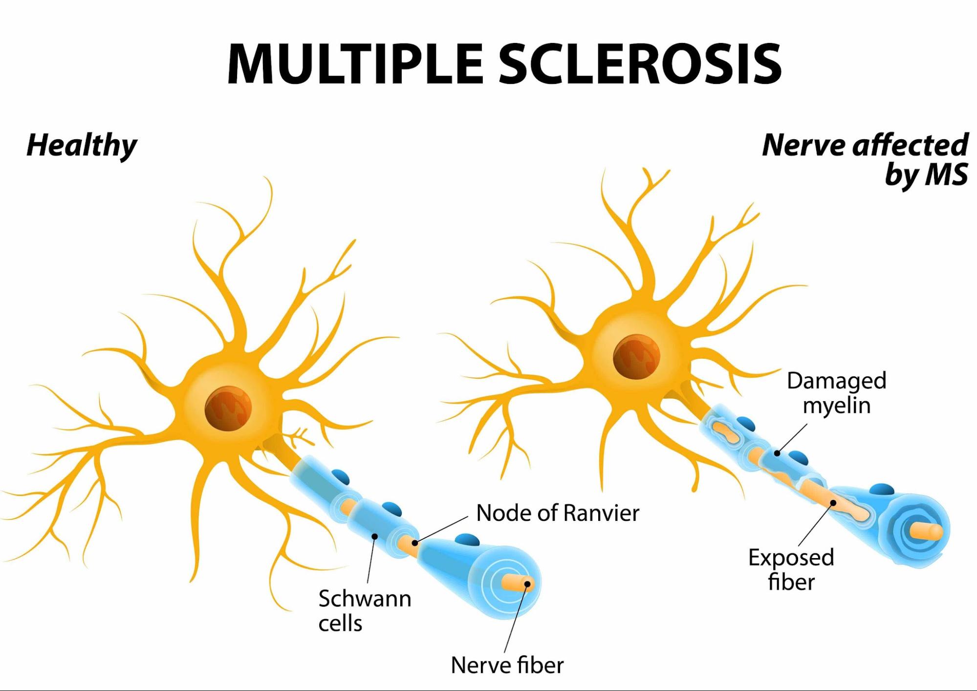 Diagram comparing healthy myelin with damaged myelin in multiple sclerosis.