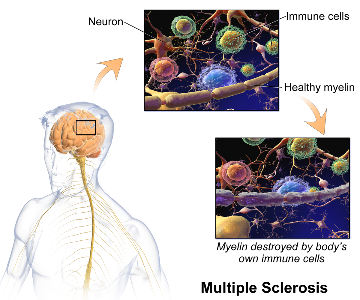 Illustration of immune cells damaging myelin in multiple sclerosis autoimmune disease activity.