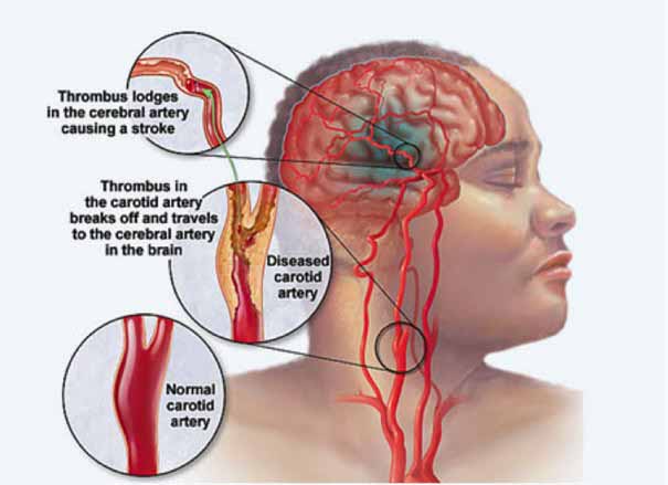 what are the after effects of a stroke